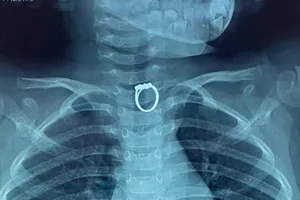 Phim chụp X-quang hiển thị chiếc nhẫn bị mắc kẹt trong thực quản bé gái