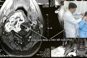 Giúp bệnh nhân bỏ u bao dây thần kinh cột sống cổ xâm lấn 