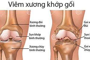 Từ biệt đau đớn do bệnh xương khớp