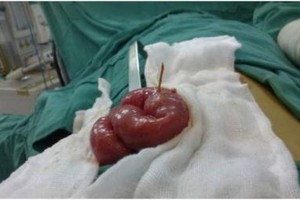 圖為接受手術中的胃腸道穿孔之嬰兒阮裴芳翠。（圖源：互聯網）