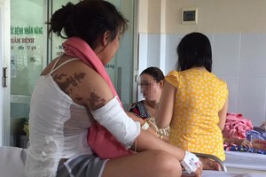 妙齡女子被潑硫酸燒傷整張背和手臂。