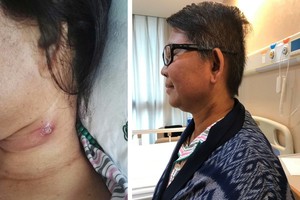 治療後頸部腫塊完全消失。