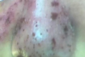 注射來歷不明玻尿酸引致鼻部的皮膚幾乎壞死。