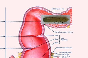 黃瓜位於乙狀結腸示意圖。