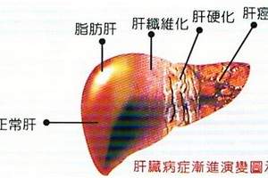 肝臟病症漸進演變圖示。（圖源：互聯網）