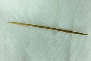 從患者小腸道中取出的整根牙籤(5釐米長)。（圖源：C.A）