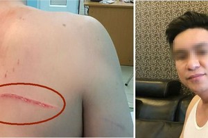 詹國泰醫生身上的傷口與傷痕。（圖源：互聯網）