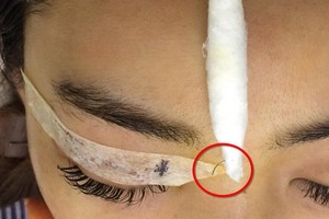 河內一名女士在某美容單位為眼部微整時，突然被1根長5毫米、直徑0.2毫米的針子(畫紅圈)刺入眼窩，隨後找不到。（圖源：醫生提供）