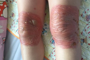 聽從熟人的指引，T女士到一家東藥店治療膝關節疼痛。敷藥３天後，她發高燒和膝蓋嚴重灼傷。