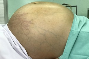 巨型卵巢腫瘤患者N.N.T.N 在手術前拍下的腹部照片。（圖源：醫院提供）