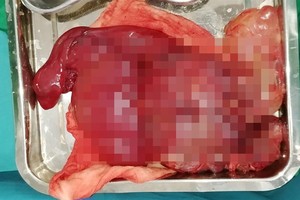 手術切割取出的淋巴管瘤。（圖源：醫院提供）