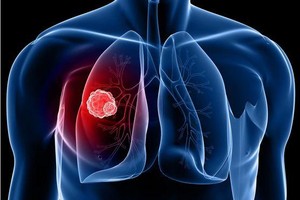 國際癌症研究中心：肺癌發病率最高。（示意圖源：互聯網）