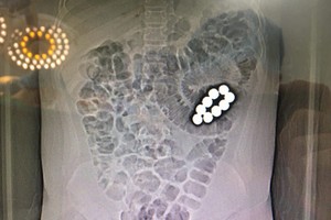 經腹部CT掃描顯出病童腹內的9顆異物位置。（圖源：醫院提供）