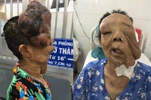 左圖起：巨型神經纖維瘤患者紅姐手術前與後。（圖源：成安）