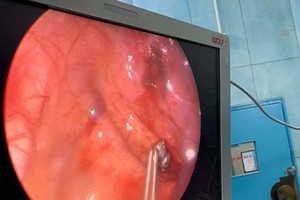 內窺鏡手術取彈過程視頻截圖。（圖源：林瑞）