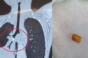 左圖：胸部CT斷層掃描結果顯示支氣管內有圓柱形物體，導致支氣管分支S9外基底段完全堵塞。右圖：經支氣管鏡取出的“塑料硬物”。（圖源：志心）