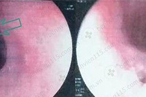 斷層掃描圖顯示異物刺穿食管。（圖源：市115人民醫院）