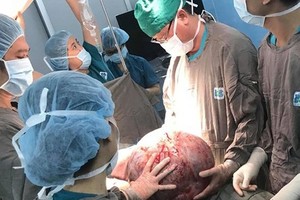 經手術取出體外的巨大卵巢腫瘤。（圖源：醫院提供）