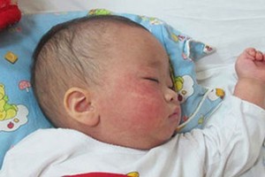 市衛生防疫中心：年初 60 幼兒罹患麻疹病。（示意圖源：互聯網）