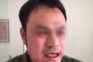 遭毆斷4顆門牙的機場安寧人員。（圖源：阮洋）