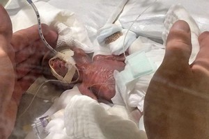 世界最小男嬰已健康出院。圖為出生時僅重 268 克的世界最小男嬰。（圖源：共同社）