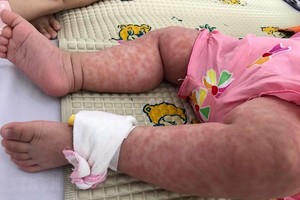 被確診的一例麻疹病例。（圖源：越通社）