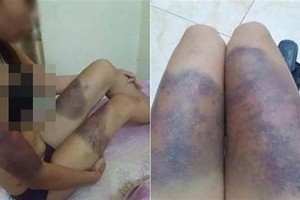 遭非法扣押毆打的孕婦阿Y遍體鱗傷。（圖源：Vietnamnet）