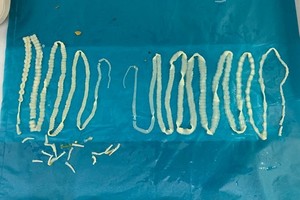 患者服用驅蟲藥後排出體外總長共約4米的兩條條蟲。（圖源：院方提供）