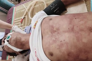 感染豬鏈球菌患者芩文化雖獲送醫院接受積極救治，但最後還是不治身亡。（圖源：何姮）