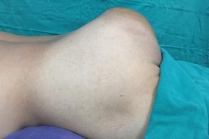 患者手術前的情況。（圖源：越通社）