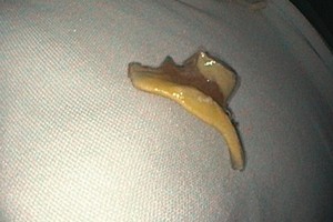 醫生採用內窺鏡技術從患者胃部取出的假牙。（圖源：嘉欣）