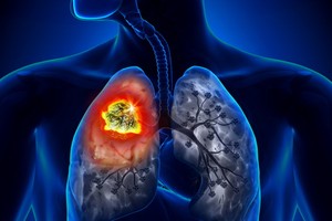 2018年，我國新增約16萬5000癌症病例，近11萬5000死亡例與逾30萬人必須與癌症共存。（示意圖源：互聯網）