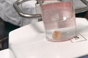 醫生採用內窺鏡技術從病童肺部取出的異物牙齒一顆。（圖源：院方提供）