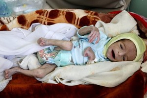 這張照片拍攝於也門首都薩那一家名為 Al-Sabaeen的醫院，很多營養不良的兒童正在這家醫院接受救治，醫生們正竭盡全力挽救這些無辜的可憐小生命。（圖源：互聯網）