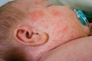 南太平洋島國薩摩亞政府22日證實，該國自10月中旬出現麻疹疫情以來，已報告麻疹病例1644例，致死20人。（示意圖源：互聯網）