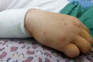 歷經多個小時的搶救手術，傷者斷臂成功接上。（圖源：Zing）