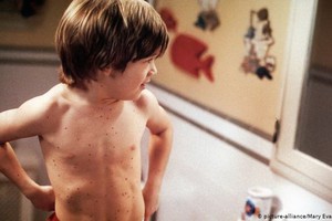 去年麻疹病例大幅上升。（圖源：互聯網）