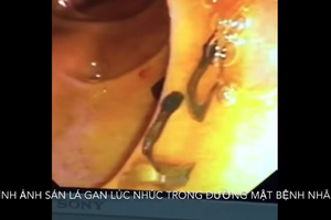 內窺鏡探查結果顯示，患者膽管內顯現許多在移動的肝吸蟲。（圖源：院方提供）