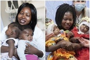 女嬰分割前後對比照，左為手術前模樣。（圖源：互聯網）