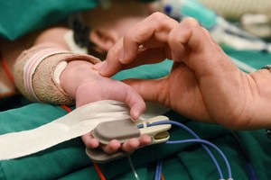 連體嬰接受分離手術12個小時後生命體征基本平穩。（圖源：緣潘）