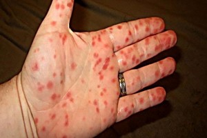 皮膚出現紅斑就是登革熱病的特徵跡象。