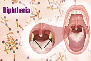 白喉桿菌只感染了咽喉部，形成很小一片白膜，但它會釋放一種叫做白喉桿菌外毒素。這種毒素可厲害了，它可使細胞水腫、壞死，心臟停跳，神經癱瘓。（示意圖源：互聯網）