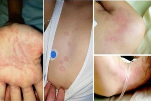 患有多系統炎症綜合徵的孩子，其皮膚上出現皮疹。（圖源：醫學網站）