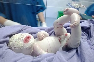 初生男嬰不幸患上全身長滿魚鱗蘚的罕見疾病。（圖源：院方提供）