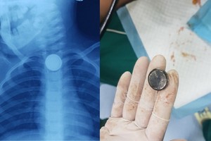 左圖：X光片上顯示，食道內有一棵類似紐扣型電池的異物卡住；右圖：經軟管內窺鏡手術從女童食道取出一棵紐扣型電池。（圖源：院方提供）