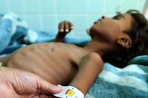 也門薩那，一名罹患營養不良的兒童正在醫院接受治療。（圖源：兒基會）