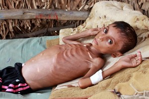 圖為也門一名飽受饑荒煎熬、瘦到皮包骨的少年。（圖源：互聯網）