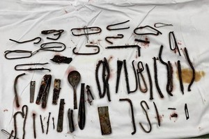 經手術從患者胃部取出體外的大量金屬異物。（圖源：院方提供）