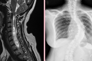 從影像學中可看出黃女士脊椎側彎角度頗大。