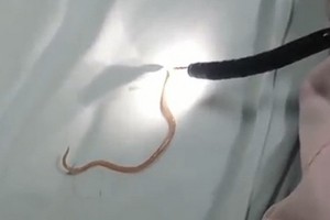 經內窺鏡手術從病童的胰管中取出一條活著長約15釐米的蛔蟲。（圖源：院方提供）